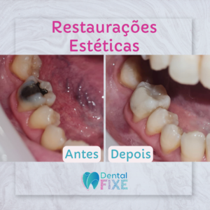 Restauração Estética